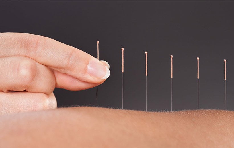 accupuncture 001 | هلومگ | ده نکته که درباره طب سوزنی باید بدانید